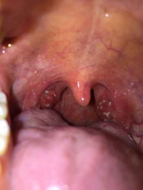 吃瓜喉咙感觉痛,揭秘喉咙不适背后的真相